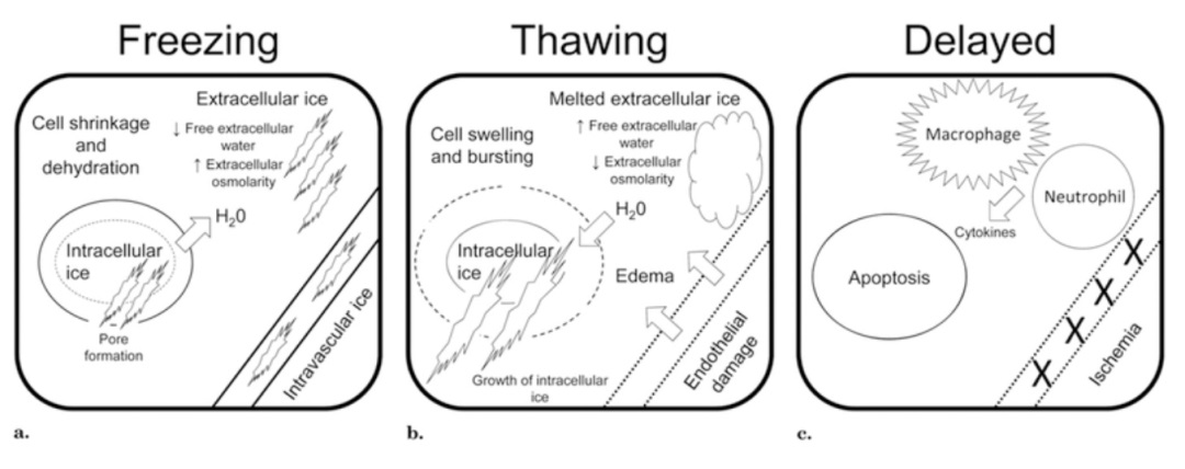 肿瘤治疗界的「高冷之花」——肿瘤微创冷冻消融,国产替代设备空间巨大