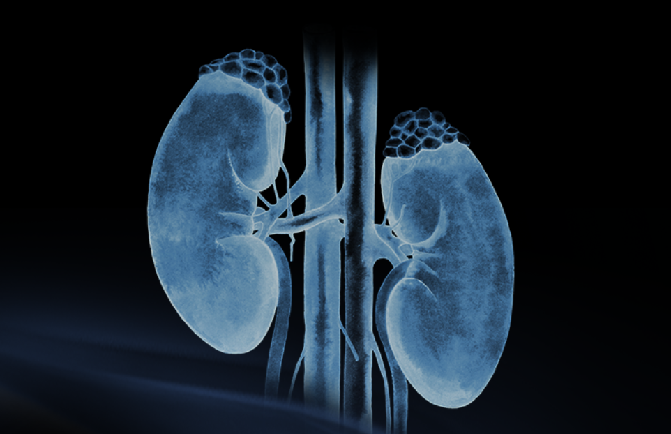 世界肾脏日 | 相得「肾」欢,融有术、精准适形